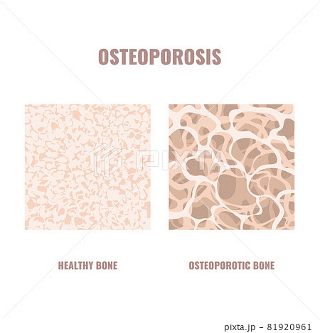 Osteoporosis bone density loss disease medical infographics 81920961