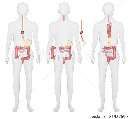 イラスト素材:食道がん・残胃・上行結腸・再建術 イラスト素材:食道がん・残胃・上行結腸・再建術 81927690