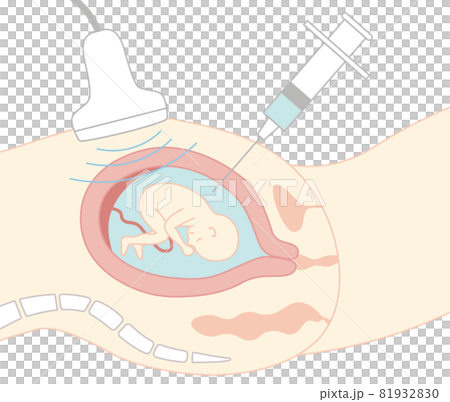 出生前診断 羊水検査 主線ありのイラスト素材 8193