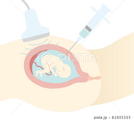 出生前診断 羊水検査 フラットテイストのイラスト素材