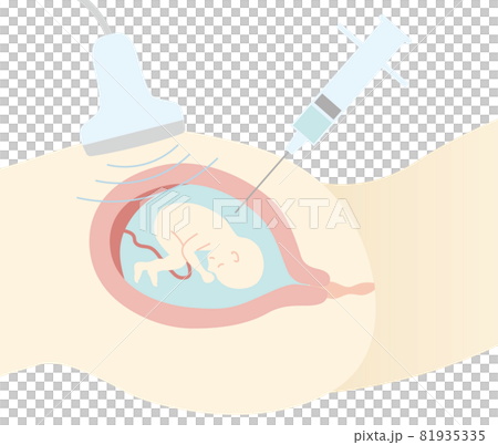 Prenatal diagnosis, amniocentesis, flat taste 81935335