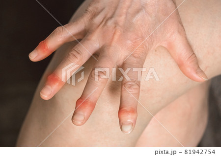 Elderly woman's hands with sore fingers. Finger treatment concept Elderly woman's hands with sore fingers. Finger treatment concept 81942754