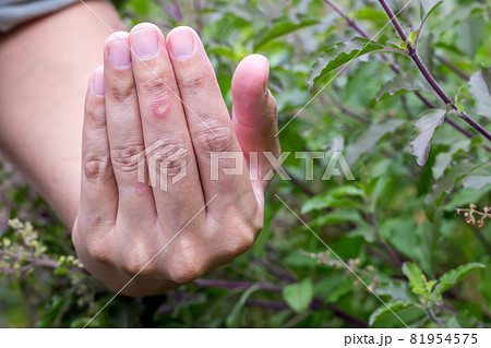 Paronychia, swollen finger inflammation due to bacterial infection on a man hand. Paronychia, swollen finger inflammation due to bacterial infection on a man hand. 81954575