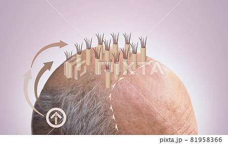 Methods of hair transplantation fut vs fue with infographic elements of illustration. Methods of hair transplantation fut vs fue with infographic elements of illustration. 81958366