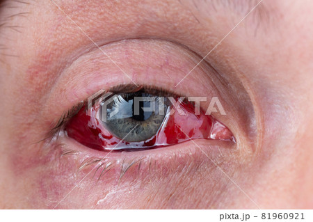 postoperative heavy inflamed eye closeup shot with selective focus 81960921
