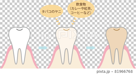 牙齒上有色污漬的插圖 81966768