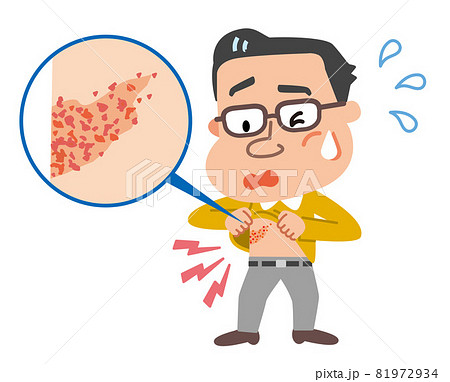 帯状疱疹　発疹を確認する中年男性のイラスト 81972934