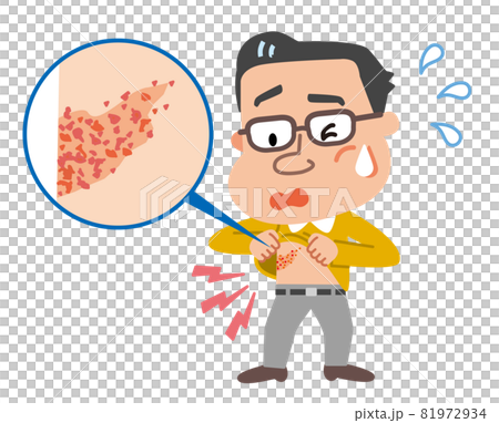 帯状疱疹　発疹を確認する中年男性のイラスト 81972934