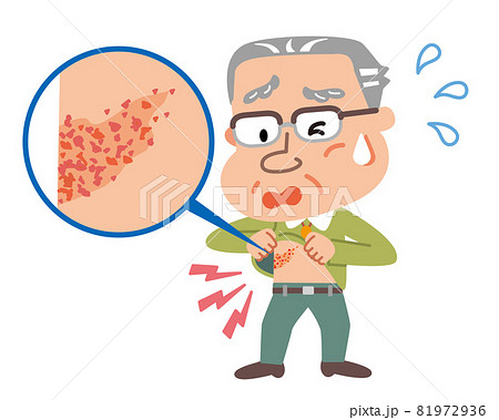 帯状疱疹 発疹を確認する高齢者男性のイラスト 帯状疱疹 発疹を確認する高齢者男性のイラスト 81972936