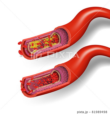 Healthy and Cholesterol Blocked Blood Vessels, medical concept, realistic vector illustration 81989498
