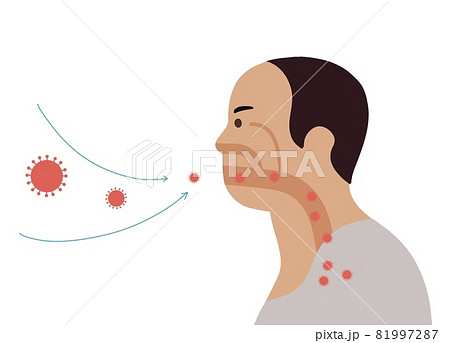 Corona Virus ,Bacteria and Fungi into respiratory of human from breathe. Illustration about air pollution 81997287
