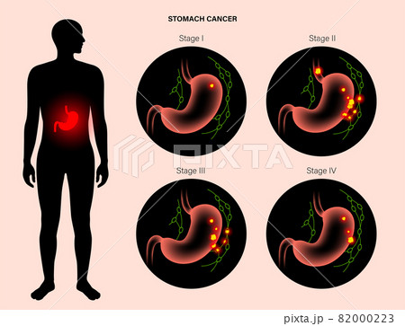 Stomach cancer anatomy 82000223