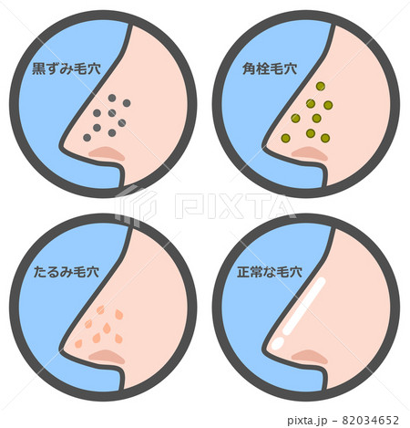 鼻の毛穴の状態を表すパターンのイラスト 82034652