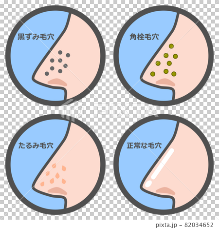 鼻の毛穴の状態を表すパターンのイラスト 82034652