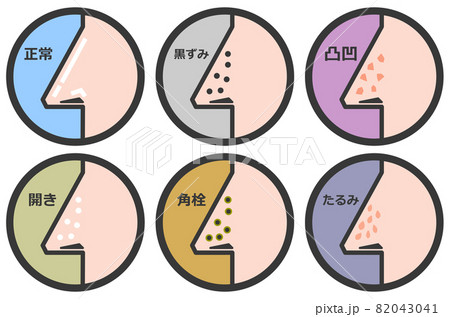 鼻の毛穴の状態を表すイラスト 82043041
