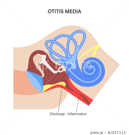 otitis media disease 82057112