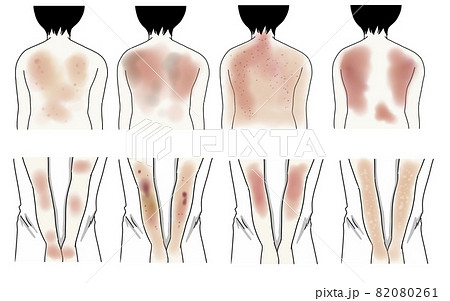 皮膚炎 腕と背中の症状イラストのイラスト素材