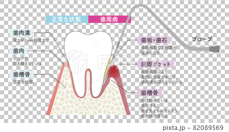用探針檢查牙周病的插圖 82089569