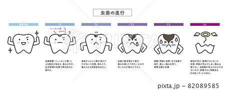 シンプル　イラスト　虫歯の進行　歯のキャラクター 82089585