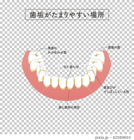 歯垢が溜まりやすい場所のイラスト 歯垢が溜まりやすい場所のイラスト 82089603