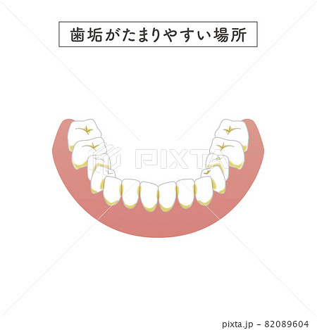 磨き残ししやすい場所のイラスト 82089604