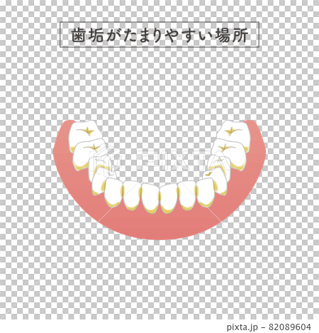 磨き残ししやすい場所のイラスト 82089604