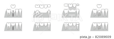 インプラント　ブリッジ　部分入れ歯　さし歯　比較イラスト 82089609