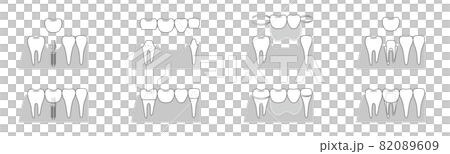 インプラント　ブリッジ　部分入れ歯　さし歯　比較イラスト 82089609