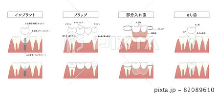 インプラント　ブリッジ　部分入れ歯　さし歯　比較イラスト 82089610
