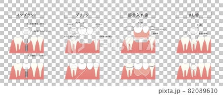 インプラント　ブリッジ　部分入れ歯　さし歯　比較イラスト 82089610