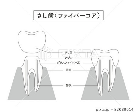 さし歯の構造イラスト 82089614
