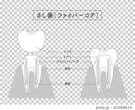 さし歯の構造イラスト 82089614