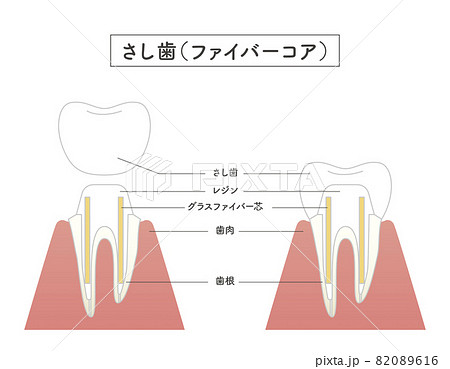 さし歯の構造イラスト 82089616