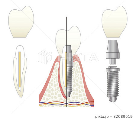 さし歯とインプラントの比較イラスト 82089619