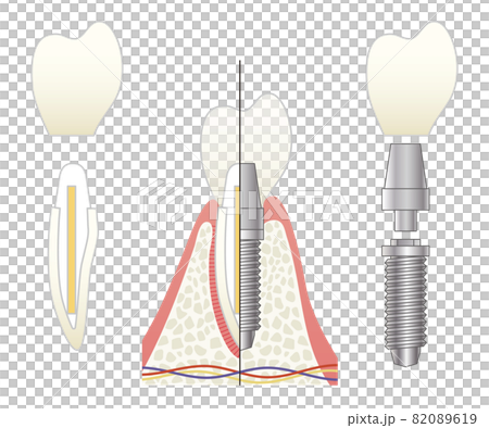 さし歯とインプラントの比較イラスト 82089619