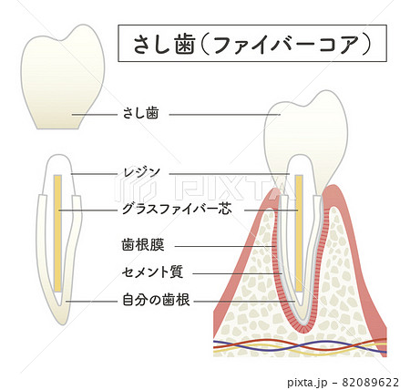 さし歯の構造イラスト 82089622