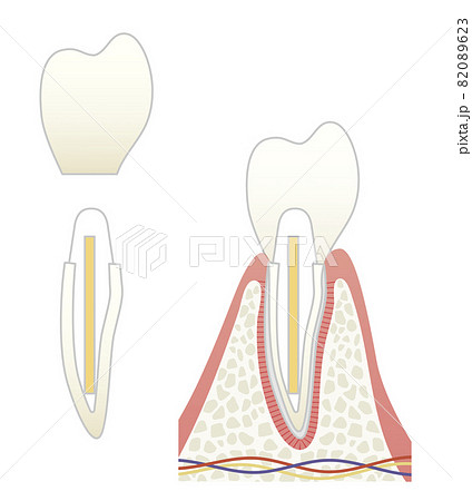 さし歯の構造イラスト 82089623