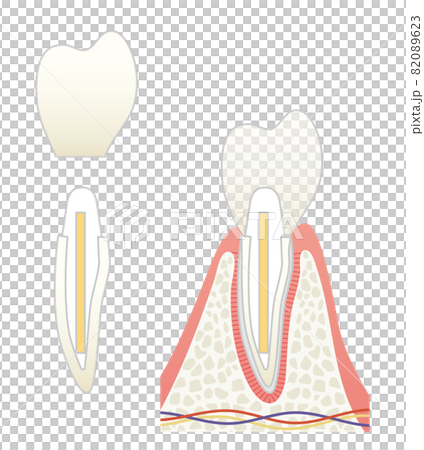 さし歯の構造イラスト 82089623