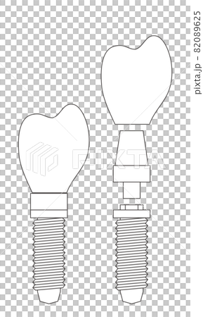 植入物的結構示意圖 植入物的結構示意圖 82089625