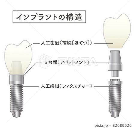 インプラントの構造イラスト 82089626