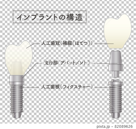 インプラントの構造イラスト 82089626