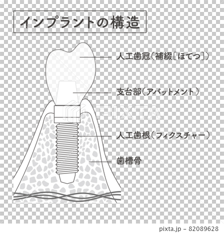 インプラントの構造イラスト 82089628