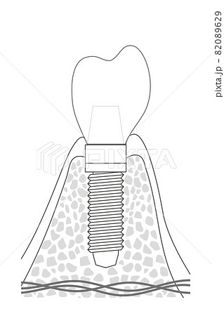インプラントの構造イラスト 82089629