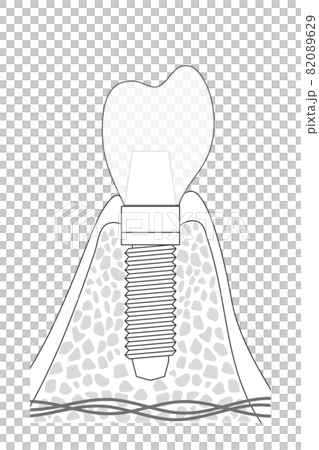 インプラントの構造イラスト 82089629