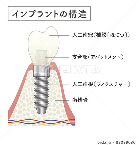 インプラントの構造イラストのイラスト素材 0630