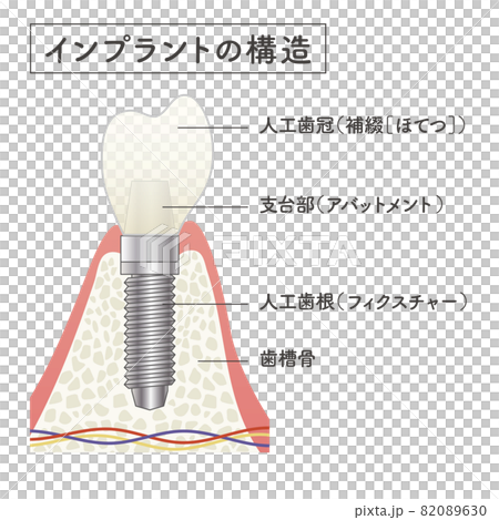 植入物的結構示意圖 82089630