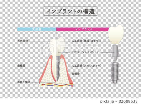 インプラントの構造イラスト 82089635