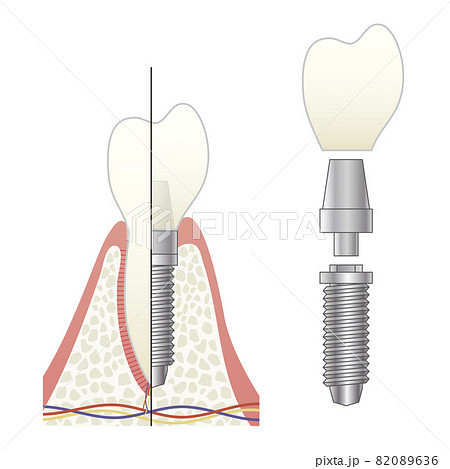 インプラントの構造イラスト 82089636