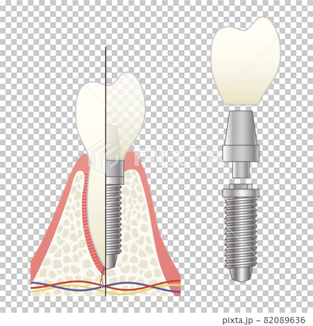 インプラントの構造イラスト 82089636