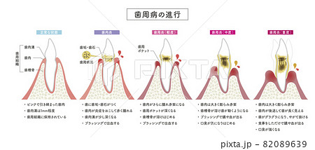 歯周病の進行 歯周病の進行 82089639